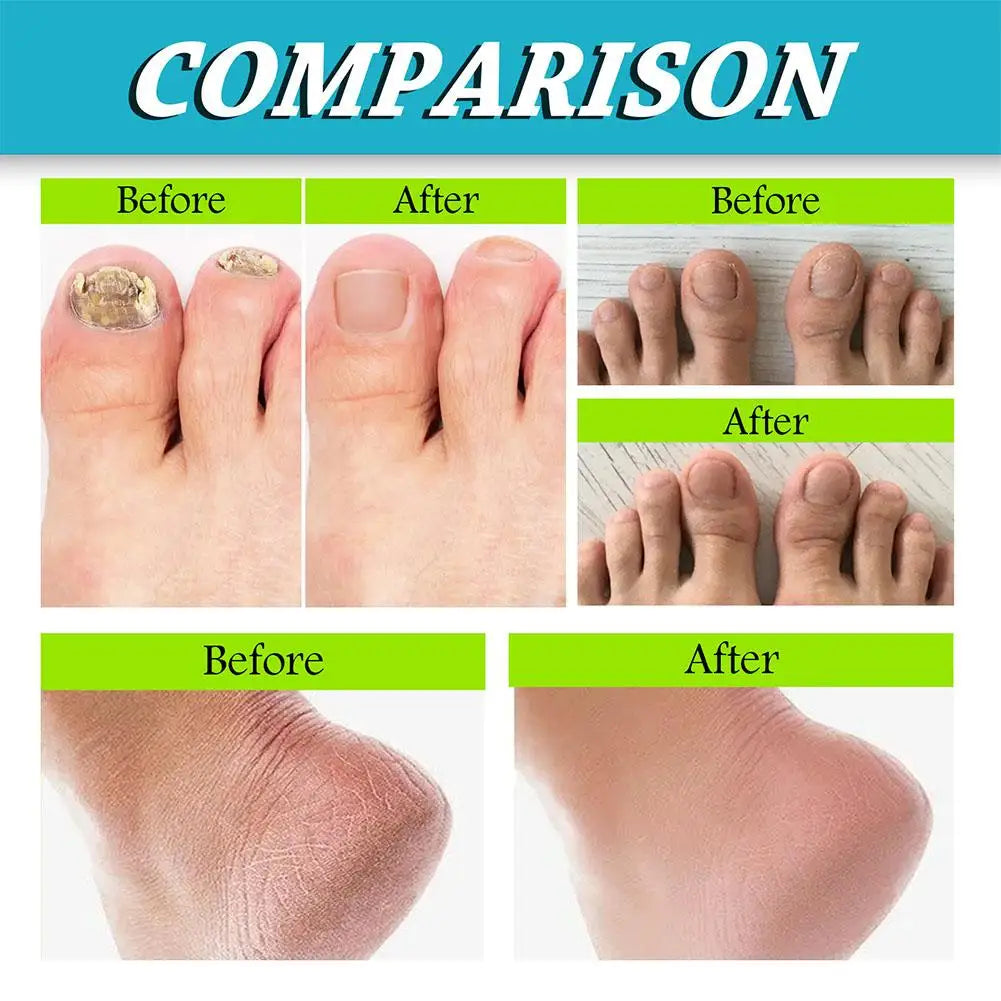 30ml Foot Care Spray Natural Deodorizing Spray Anti Drying Crack Foot Care Tool nail care spray